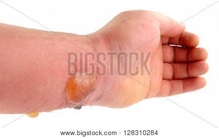 Arm with blisters caused by a severe allergic reaction cause by a horse fly insect bite isolated on a white background