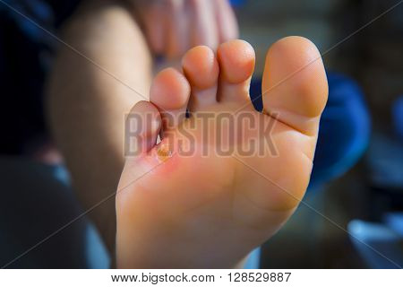 Calluses On Foot