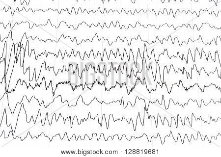 Electroencephalography test that shows electrical activity of the brain.