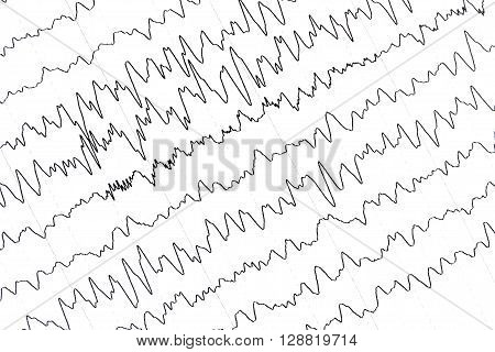 Electroencephalography test that shows electrical activity of the brain.