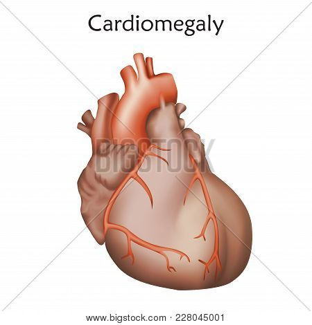 Cardiomegaly. Enlarged Heart Muscle. Anatomy Illustration. Colorful Image White Background
