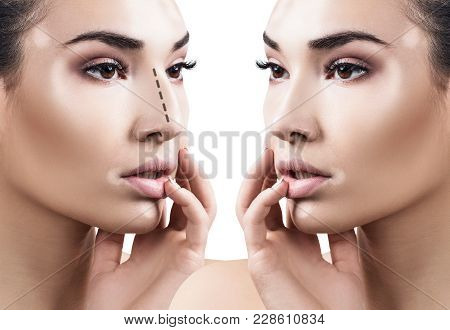 Portrait Of Female Nose Before And After Cosmetic Surgery. Rhinoplasty Concept.