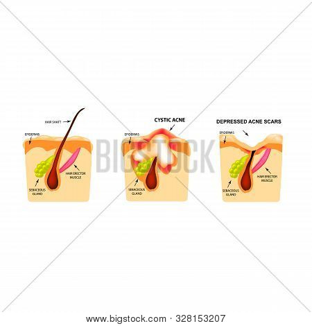 Comedones, Inflamed Acne, Cysts. Inflamed Pimples. The Structure Of The Skin. Scar Acne And Pimples.