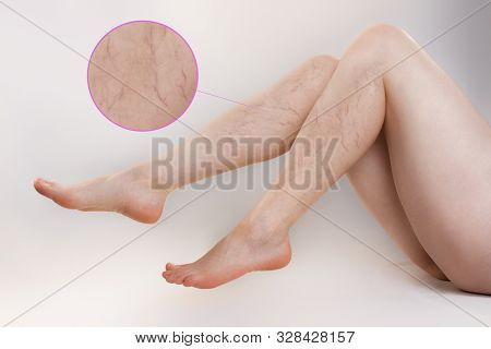 The Concept Of Varicose Disease And Cosmetology. The Woman Sits, Playfully Spreading Her Slender Leg