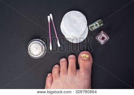 Flat Lay. Fungus On The Toenail. Cream In A Jar, Cotton Pads And Cotton Buds, Bottles Of Liquid. Dar