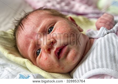 Newborn Acne Neonatorum On Baby Face. Close Up View