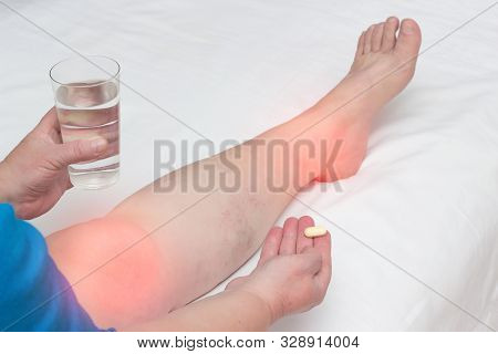 A Woman Whose Leg Pain In The Joints Holds A Pill And A Glass Of Water. The Concept Of Treatment Of 