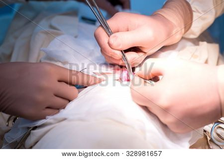 Hands Of A Pediatric Surgeon Close-up, Using A Tool To Separate The Elements Of The Spermatic Cord.