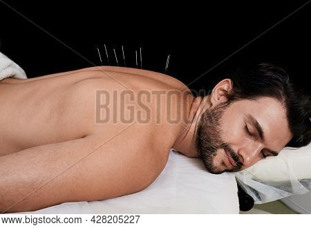 Patient Receiving Body Acupuncture Procedure Lying Down In China Medical Clinic. Man With Acupunctur