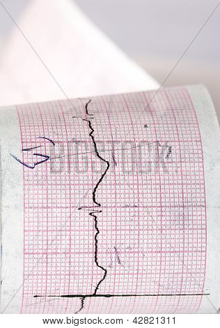 Elektrokardiyogram Ctg