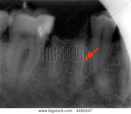 Hampaat Xray