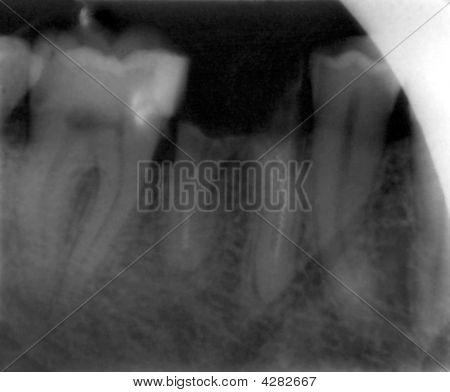Hampaat Xray