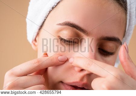 Girl Squeezing Pimples On Face. Acne Blemish Spots Skin On Young Woman. Spot Scar Acne, Freckles, An