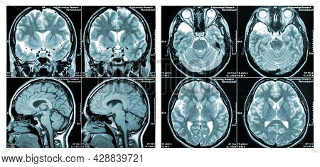 Mri Scan Image Of A Human Brain Showing All Main Multiple Sclerosis