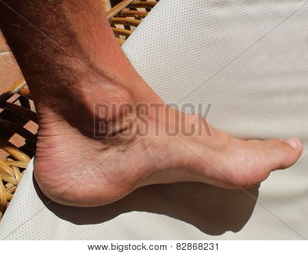 Hallux Foot