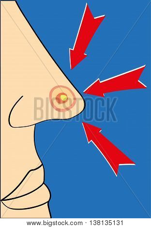 Close up of a nose with a large red spot or pimple with a white head and three red arrows pointing at it