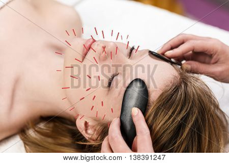 Woman undergoing acupuncture treatment with a line of fine needles inserted into the skin of her forehead
