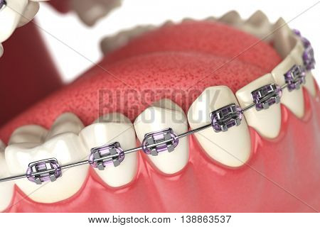 Teeth with braces or brackets in open human mouth. Dental care concept. 3d illustration