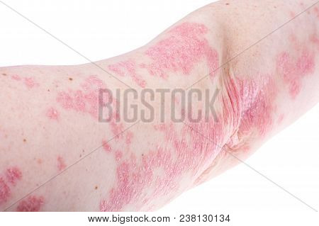 Dermatological Skin Disease Psoriasis, More Pronounced On Elbow, Hand. Redness And Dry Patches, Alle