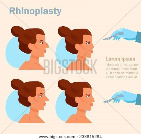 Rhinoplasty. Plastic Surgery Vector. Cartoon. Isolated Art On White Background. Flat