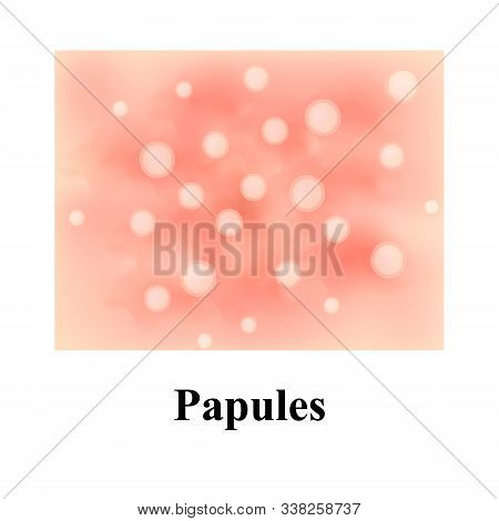 Papules On The Skin. Acne. Pimples On The Skin. Infographics. Vector Illustration.