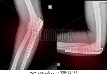 X-ray Elbow An Olecranon Fracture My Be Held Together With Plate And Screws.this Is Called A Tension