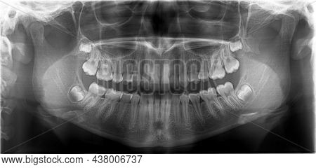 X Ray Of Growing Teeth Using The Panoramic Orthopantomography Technique. Some Teeth Such As The Wisd