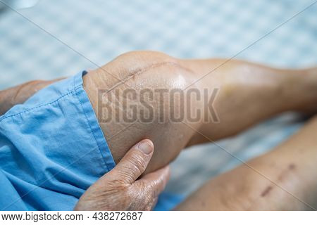 Asian Senior Or Elderly Old Lady Woman Patient Show Her Scars Surgical Total Knee Joint Replacement 