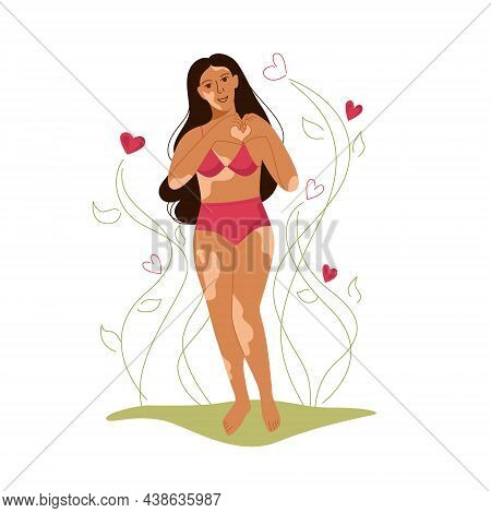 Cute Girl With Vitiligo. Body Positive, Self Love, Depigmentation Disease, Accepting Your Body. Inte