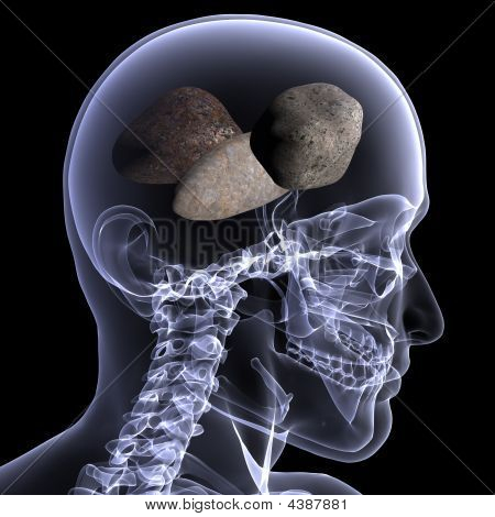 Radiographie squelette-roches dans sa tête