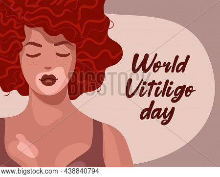 Beautiful Redhead Woman, Vitiligo On Bright Skin And Wavy Curly Hair. Body Positive Concept Vector I