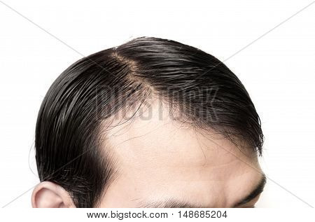 Closeup young man serious hair loss problem for hair loss concept