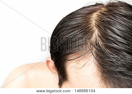 Closeup young man serious hair loss problem for hair loss concept