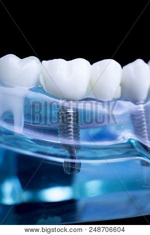 Dentist Dental Teeth Implant