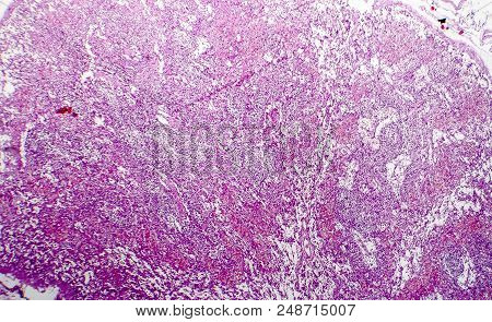 Hemorrhagic Lymphadenitits, Lymph Node Inflammation And Hemorrhage, Light Micrograph, Photo Under Mi