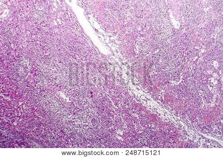 Hemorrhagic Lymphadenitits, Lymph Node Inflammation And Hemorrhage, Light Micrograph, Photo Under Mi