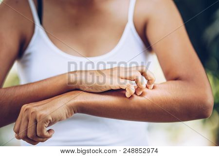 Young Women Hand Scratch The Itch On The Arm, Healthcare And Med