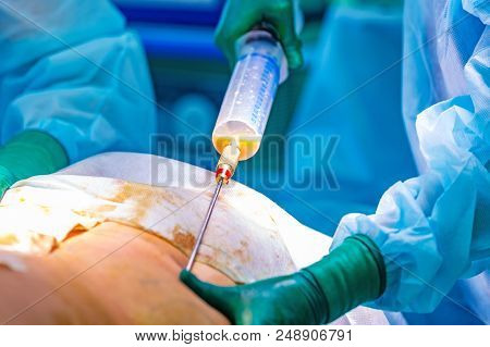 Cosmetic Liposuction Surgery In Operating Room Setting Showing Surgeon Hands And Cannula