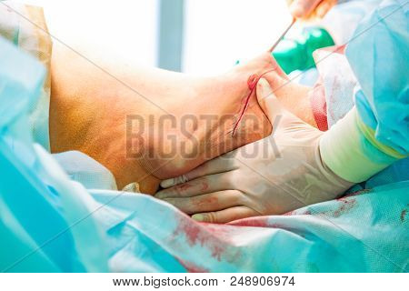 Cosmetic Liposuction Surgery In Operating Room Setting Showing Surgeon Hands And Cannula