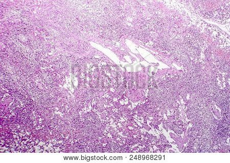 Hemorrhagic Lymphadenitits, Lymph Node Inflammation And Hemorrhage, Light Micrograph, Photo Under Mi