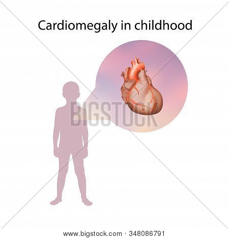 Cardiomegaly In Childhood. Enlarged Heart Muscle. Medical Anatomy Illustration.