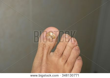 Young Guy Barefoot Fingers With Sick Onycho Mycosis Nails, Dermatologic Medical