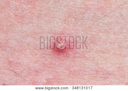 Close-up Of Whitehead Pimple On Human Skin.