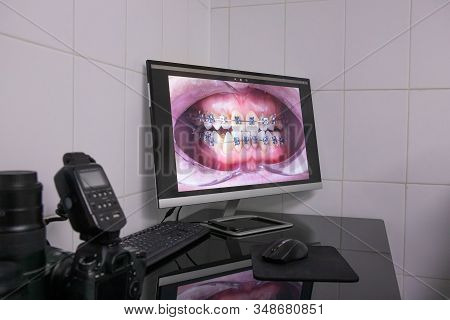 Photograph Of A Jaw With Braces On A Computer Monitor. Orthodontics, Photographic Protocol