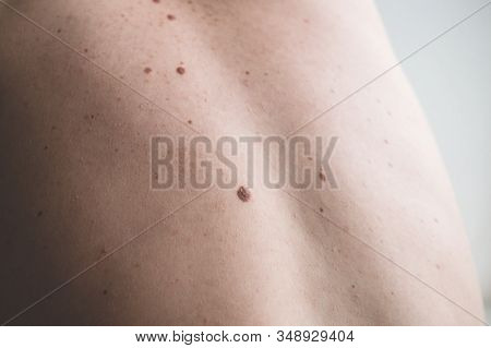 Checking Benign Moles. Close Up Detail Of The Bare Skin On A Man Back With Scattered Moles And Freck