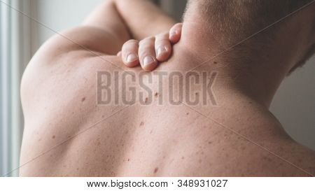 Checking Benign Moles. Close Up Detail Of The Bare Skin On A Man Back With Scattered Moles And Freck