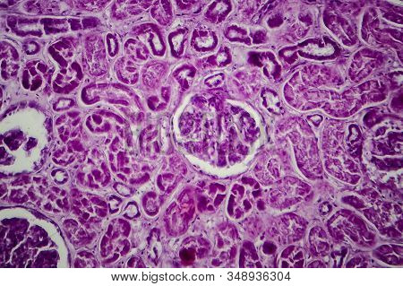 Diffuse Proliferative Glomerulonephritis, Dpgn, Light Micrograph, Photo Under Microscope