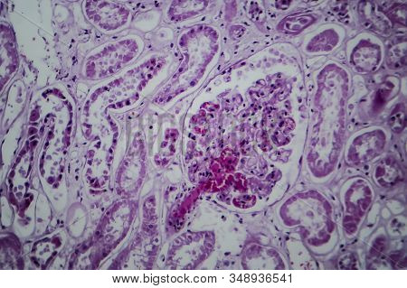 Acute Glomerulonephritis, Light Micrograph, Photo Under Microscope