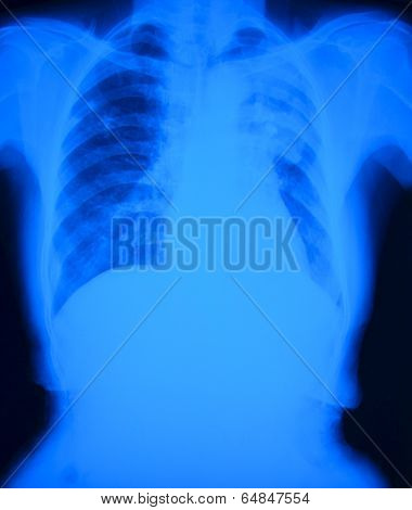 Chest x-ray film of patient with pulmonary tuberculosis