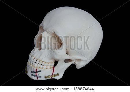 Resin Skull is Broken jaw was fixed by seizing Plate screw. On Black Background.